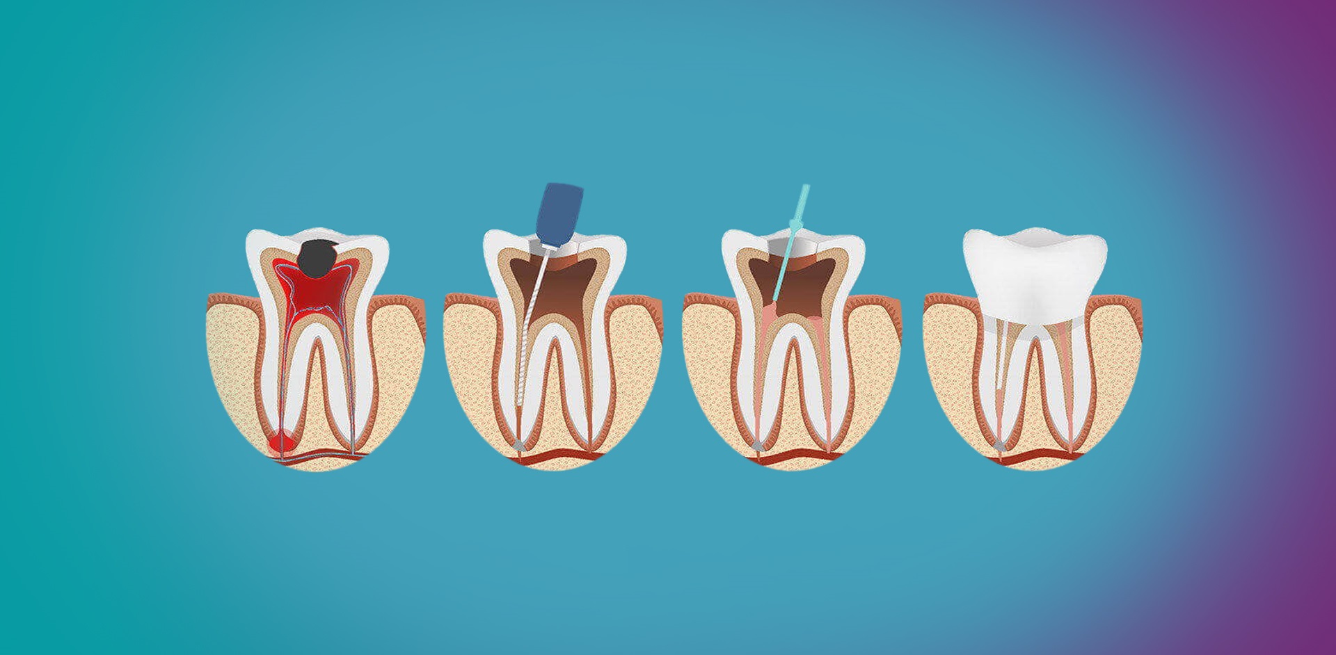 Root Canal Treatment